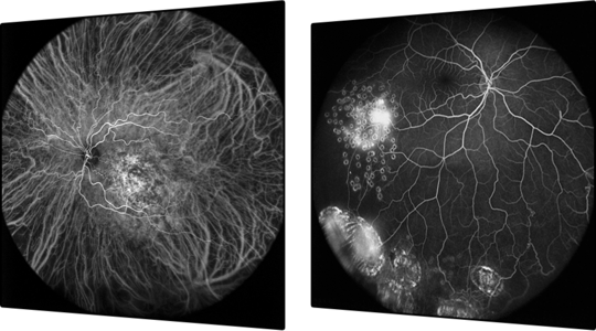 Ultra-wide-field fundus photographs and ultra-wide-field