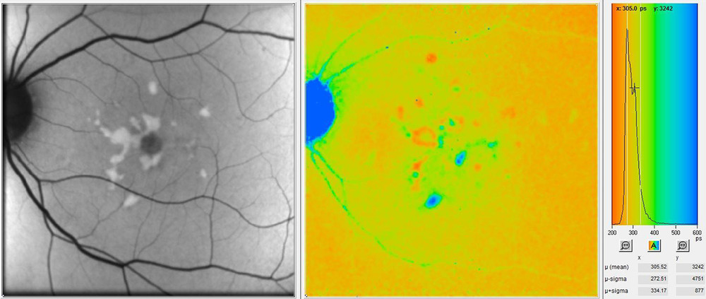 Hyperfluorescent flecks showing variable lifetimes in Stargardt disease Photo: Chantal Dysli, Inselspital Bern, CH