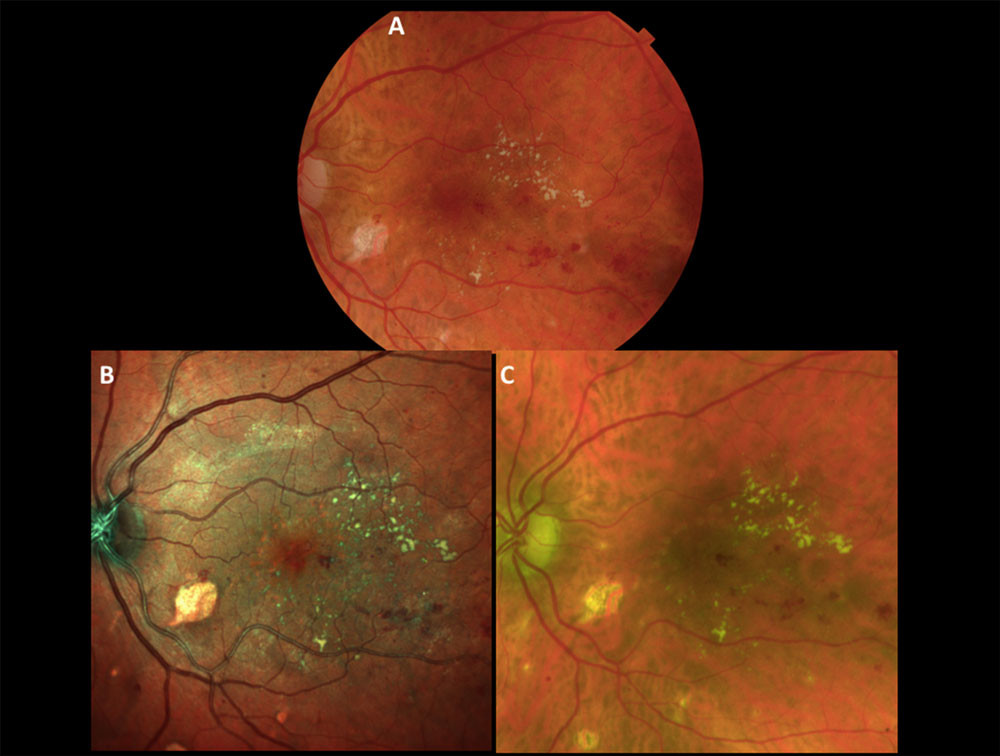 MultiColor shines at ARVO in comparisons to color fundus photography
