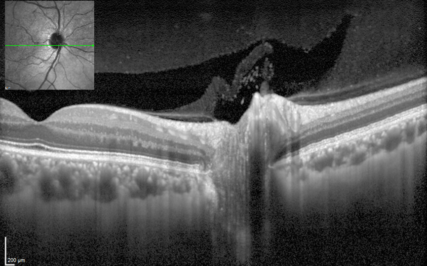 SPECTRALIS OCT2 Module - Next generation OCT | Heidelberg Engineering