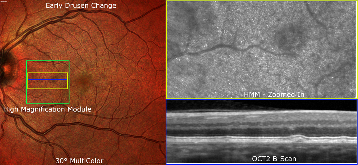Early Drusen Change