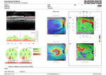 SPECTRALIS GMPE Hood Glaucoma Report now with deviation maps