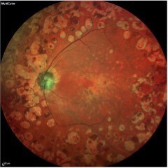 SPECTRALIS OCT shows significant disruption of the neurosensory retina and the underlying retinal pigment epithelium (RPE)