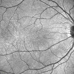 The Core DNA of the SPECTRALIS: Confocal Fundus Image