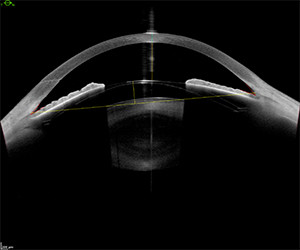 Anterior Segment Imaging and Measurements