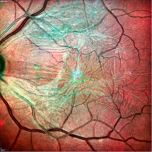 Epiretinal membrane. Picture courtesy of Dr. Oliver Schapp, Wertheim, Germany.