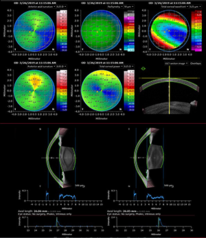 Cornea alaysis and full biometry