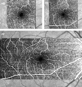 High Resolution (HR), High Speed (HS) and Full Field (FF) OCT Angiography images
