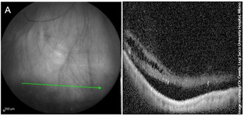 Widefield OCT scan of the retinal periphery showing clearly distinct retinoschisis and retinal detachment.