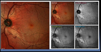 Image courtesy of Dr. James Fanelli, Cape Fear Eye Institute, Wilmington, Delaware (USA)