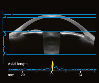 ANTERION Axial Length