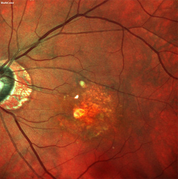 Image courtesy of Anna Tan, Singapore National Eye Center, Singapore