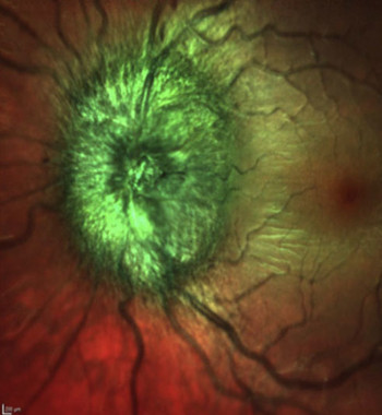 True Papilledema or pseudopapilledema