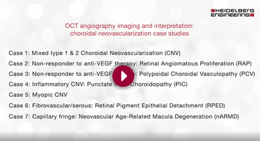 Systematische Beurteilung choroidaler Neovaskularisationen (CNV) mit Hilfe des SPECTRALIS OCT-Angiografie-Moduls