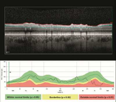 https://media.heidelbergengineering.com/uploads/News/2021/11/02112021-Glaucoma-Progression-Using-High-Density.jpg