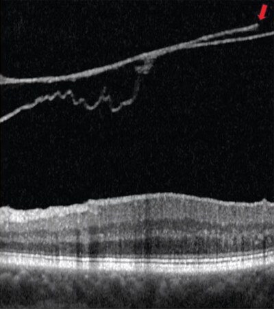 A break in the posterior vitreous cortex appears (arrow)