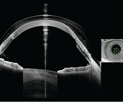 High resolution imaging along 5, 16.5 mm radial scans. This allows for a quick and comprehensive assessment of the fit of the scleral lens