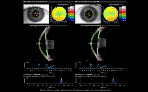 ANTERION Cataract App