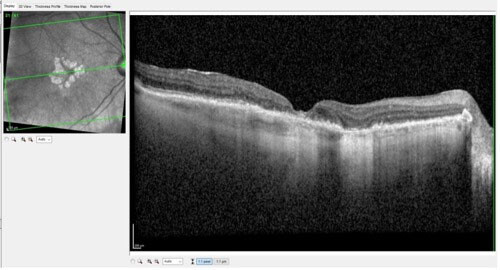 The left eye of a patient with geographic atrophy.