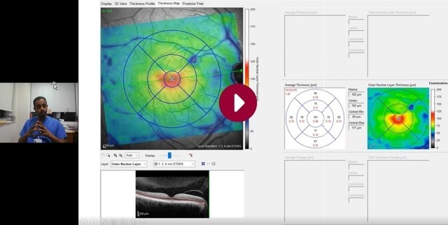 An objective method for diagnosing hydroxychloroquine maculopathy