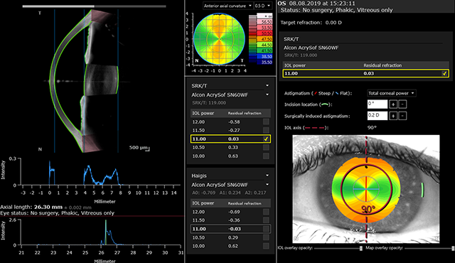 Cataract App - OCT-Schnittbild, Achsenlängenmessung, Hornhautkarten sowie sphärischer und torischer IOL-Kalkulator eines Auges mit Astigmatismus.