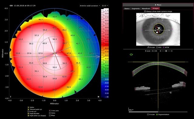 Keratoconus eye: Anterior axial curvature, infrared camera image, and OCT image