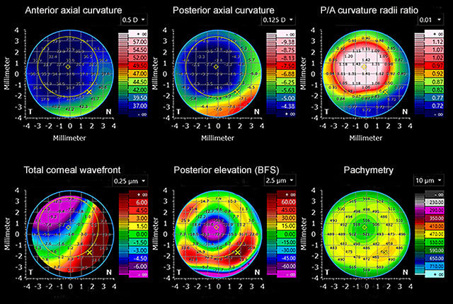 Figure 2: Corneal maps detailing the anterior and posterior corneal surfaces of eyes after refractive surgery.