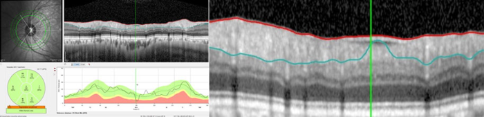 Fixing a segmentation artifact: Here the posterior border of the RNFL is incorrectly defined due to an epiretinal membrane.