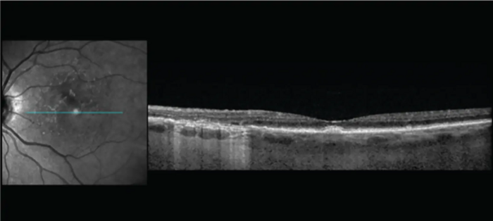 High-resolution imaging provides clear details of early degeneration of the outer retina.