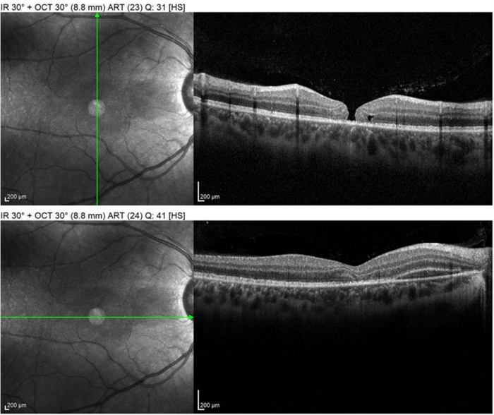SPECTRALIS OCT shows Macular hole, subretinal hemorrhage, loss of photoreceptor layer