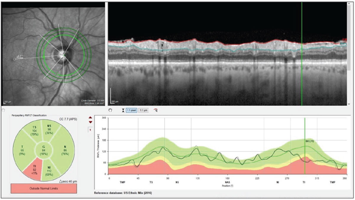 20251007_retinal_nerve_fiber_layer_scan