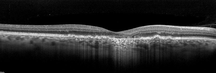 Image 2: SPECTRALIS high-resolution OCT image courtesy of Dr. Rosa Dolz-Marco, Valencia, Spain