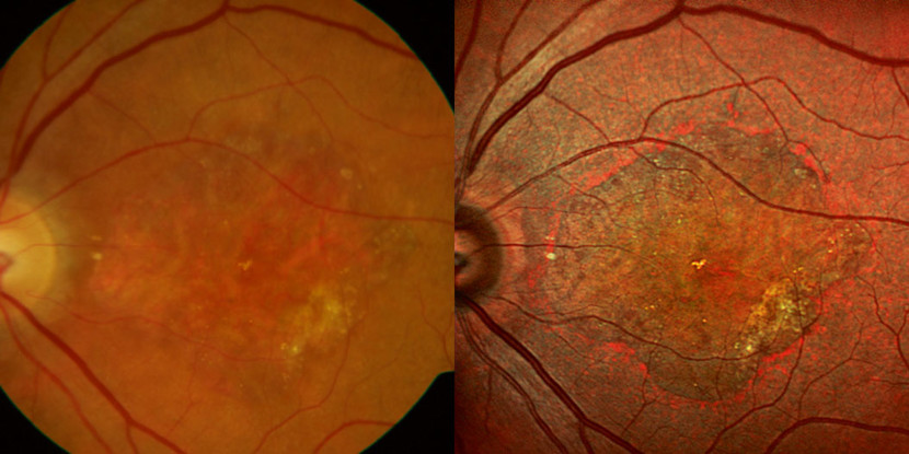 Fundus Camera image (left) in comparison to MultiColor (right) in GA