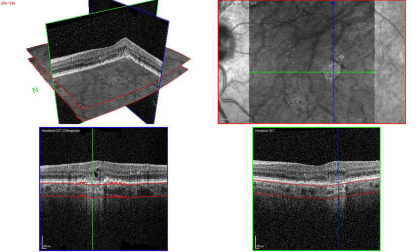Transverse section OCT – choroidal hypertransmission defect recorded with SPECTRALIS
