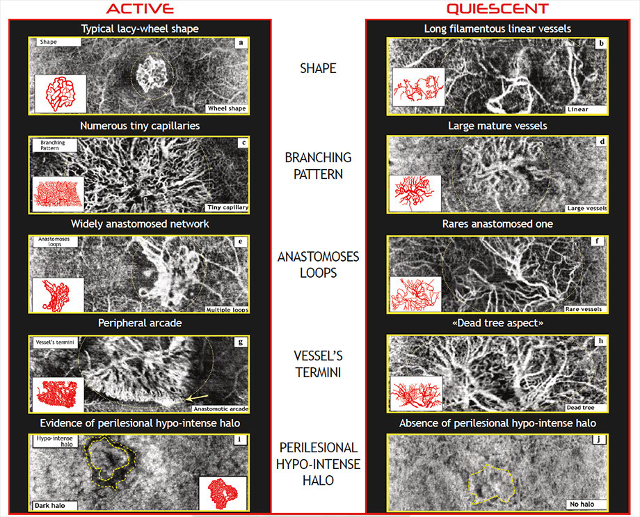 Prof. Coscas‘ criteria to identify an active CNV lesion